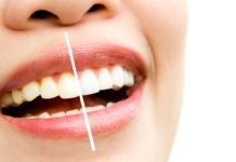Best-Ways-to-Make-White-of-Your-Yellow-Teeth-Easily-on-passionarticles