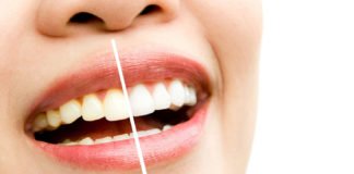 Best-Ways-to-Make-White-of-Your-Yellow-Teeth-Easily-on-passionarticles
